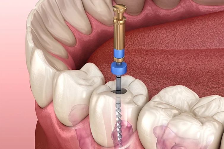 Root Canal Treatment