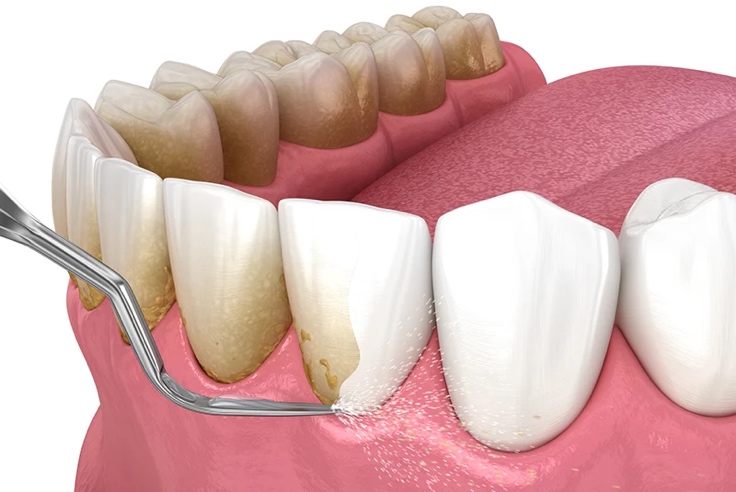 Teeth Cleaning